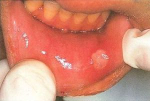 aphthous_ulcers-394